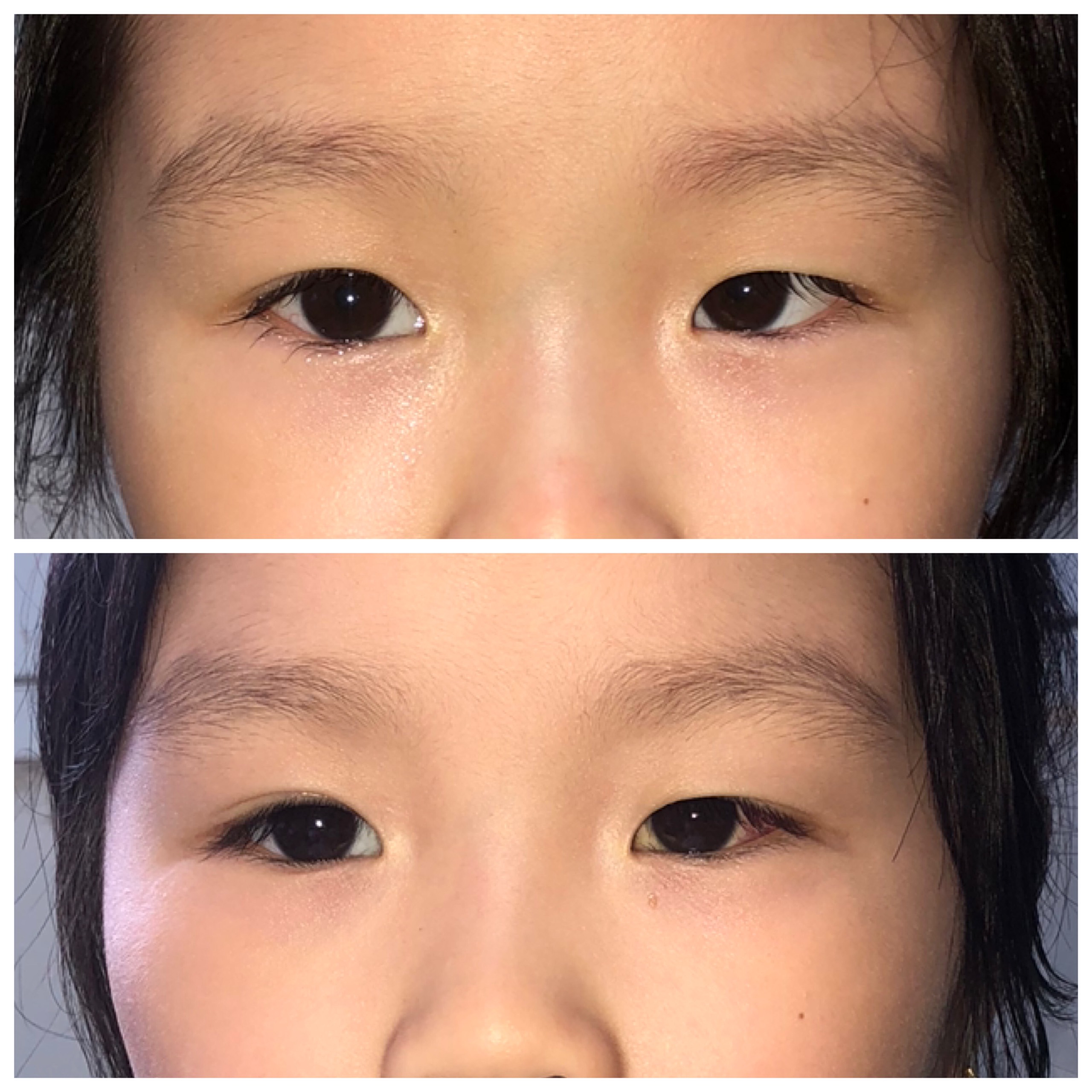 Hình ảnh mắt bé M trước và sau phẫu thuật