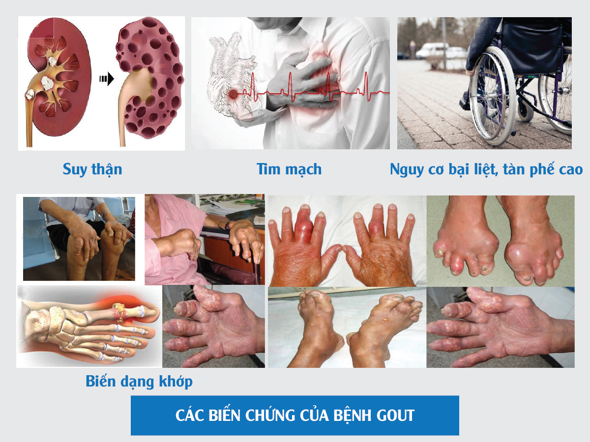 Các biến chứng của bệnh gout