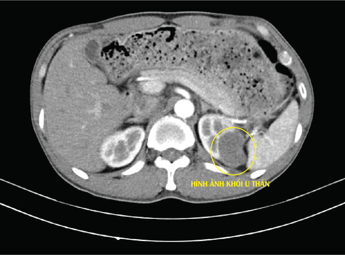 Hình ảnh phim chụp phát hiện khối u thận