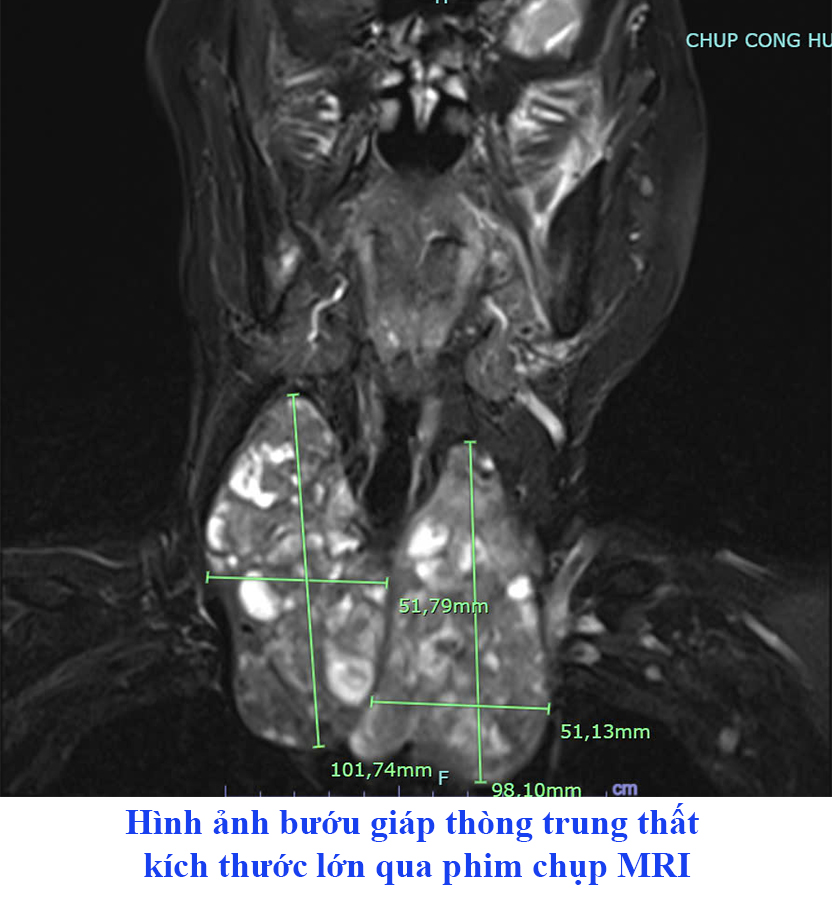 Hình ảnh bướu tuyến giáp thòng trung thất kích thước lớn qua phim chụp MRI