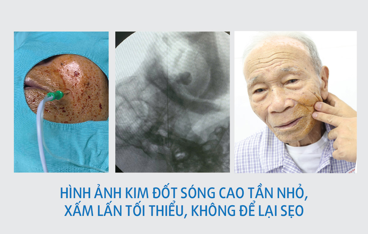 Hình ảnh kim đốt có kích thước nhỏ, xâm lấn tối thiểu, không để lại sẹo cho người bệnh