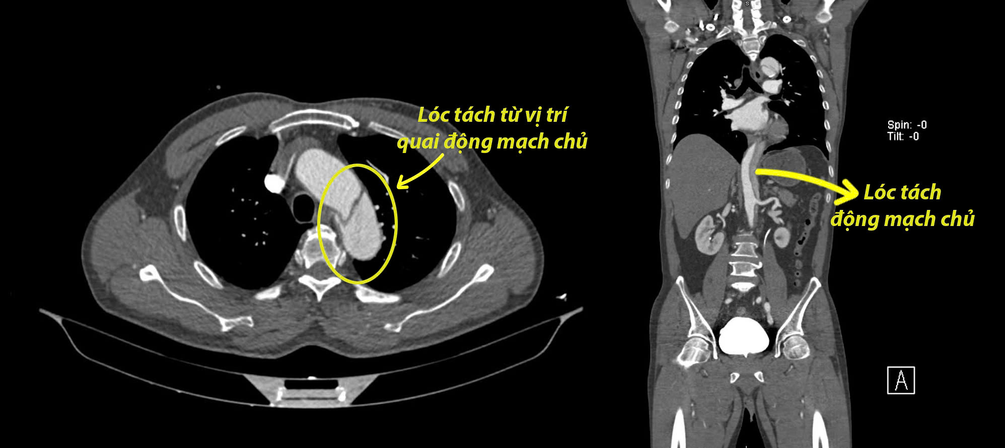 Hình ảnh phim chụp CT cho thấy Lóc tách động mạch chủ ngực ngay sát quai động mạch chủ, lóc tách lan đến chỗ chia của động mạch chậu