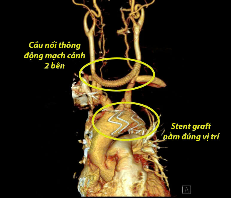 Hình ảnh phim chụp: Động mạch chủ ngực sau khi được đặt Stent và hình ảnh cầu nối động mạch cảnh hai bên bằng mạch máu nhân tạo