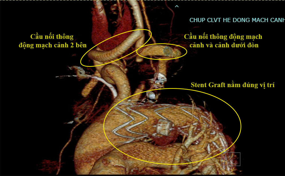 Hình ảnh phim chụp: Động mạch chủ ngực sau khi được đặt Stent và hình ảnh cầu nối động mạch cảnh – cảnh và cảnh dưới đòn bằng mạch máu nhân tạo