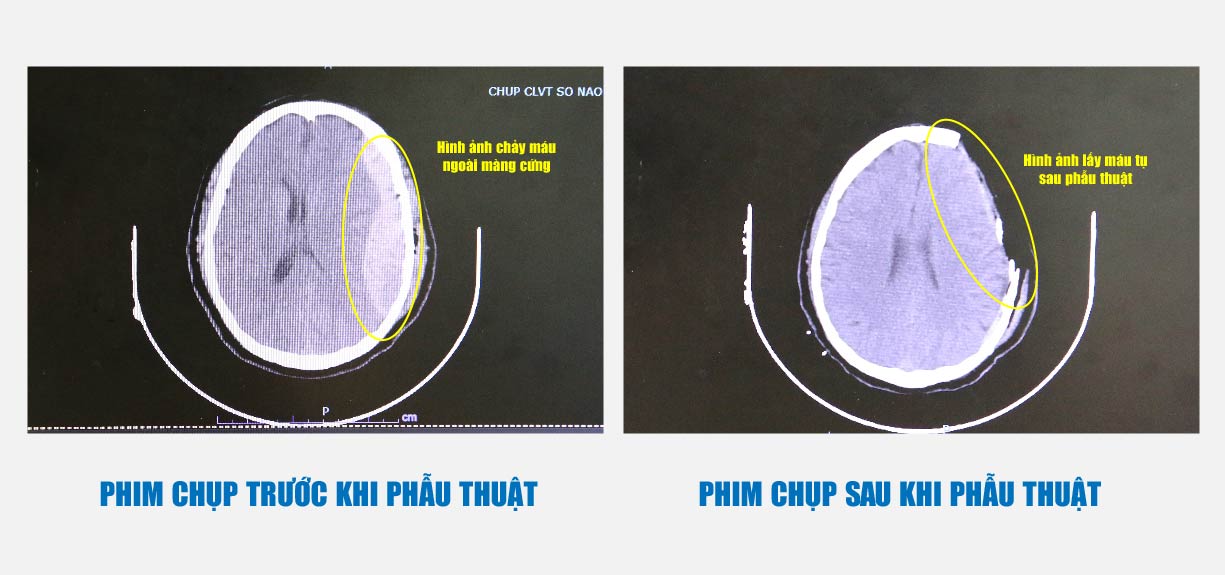 Hình ảnh phim chụp trước và sau khi phẫu thuật lấy máu tụ