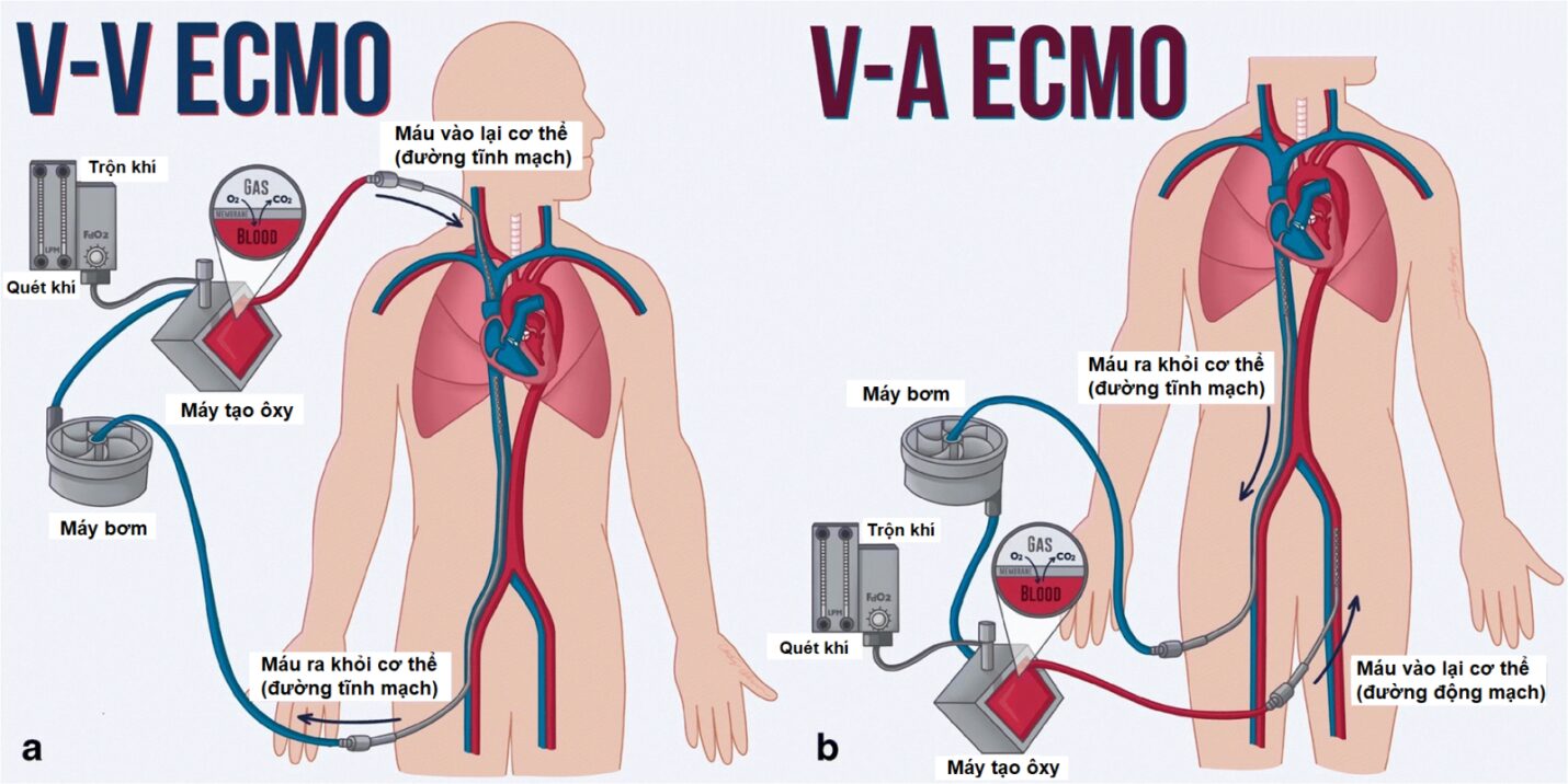 ecmo