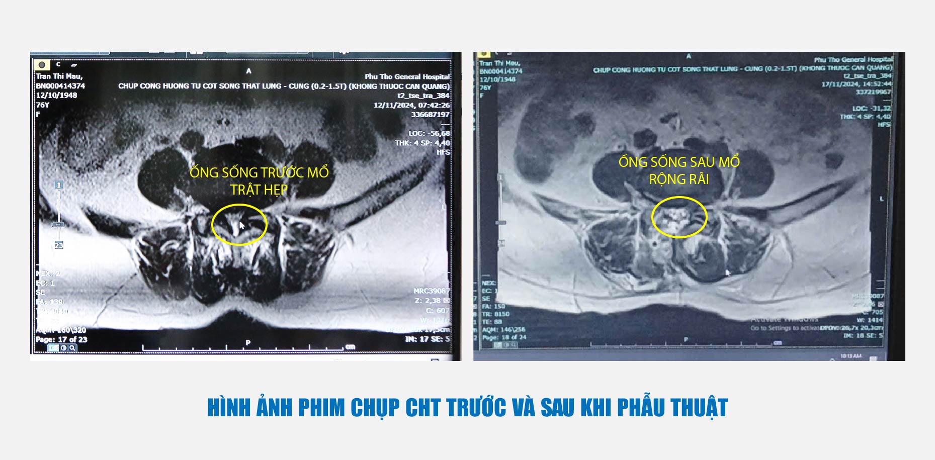 Hình ảnh phim chụp CHT trước và sau khi phẫu thuật