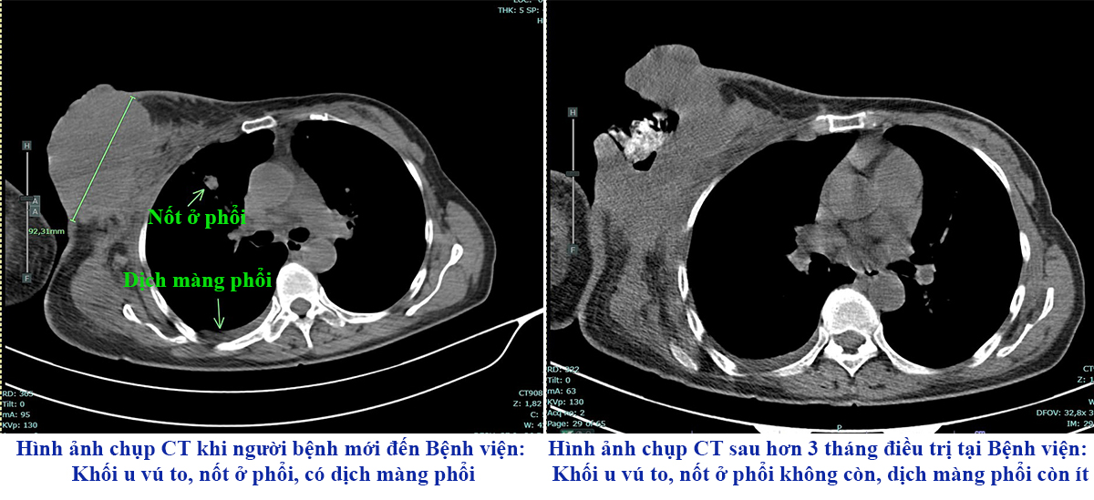 Hình ảnh chụp CT trước và sau điều trị của người bệnh