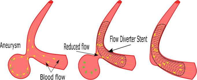 Hình ảnh mô tả hướng dòng máu đi vào túi phình và hình ảnh hướng dòng máu sau khi đặt stent cũng như hình ảnh túi phình nhỏ dần lại sau đặt stent