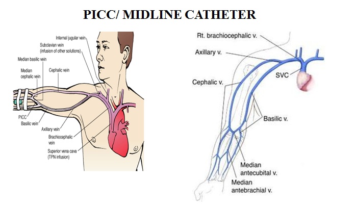 Hình ảnh minh họa đường truyền PICC/Midline