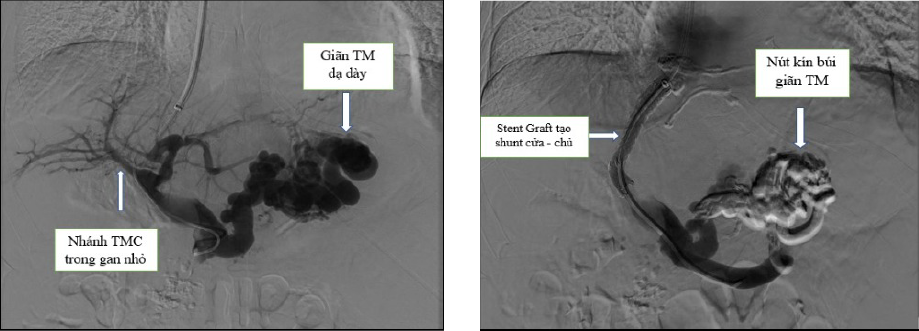 Kỹ thuật TIPS trên một ca bệnh chảy máu do giãn tĩnh mạch