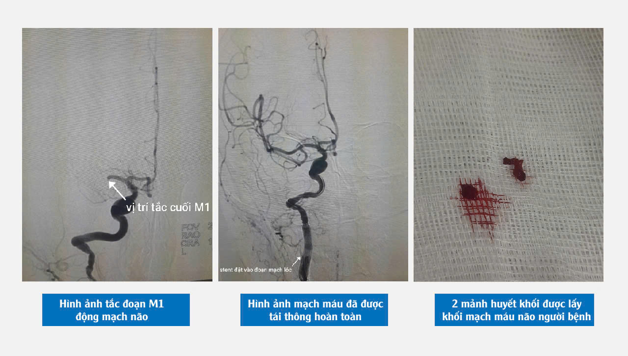 Người bệnh đột quỵ hồi phục ngoạn mục chỉ sau 12 giờ can thiệp
