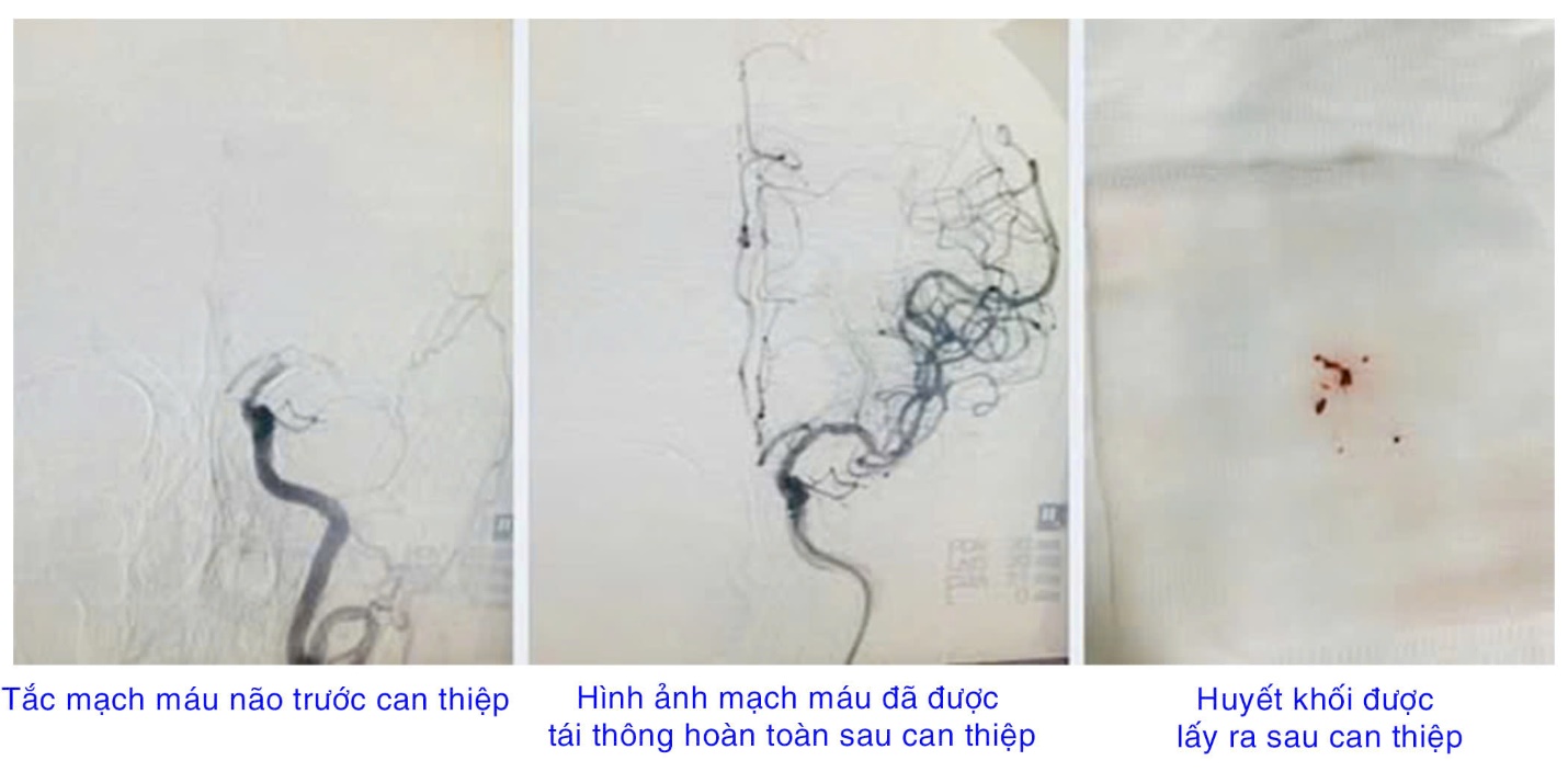 Được cấp cứu kịp thời, nhiều người bệnh cao tuổi bị đột quỵ thoát nguy cơ tử vong