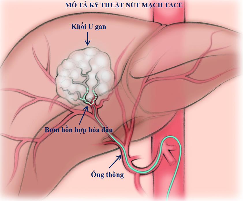 Điều trị ung thư gan bằng kỹ thuật TACE dưới hướng dẫn máy chụp mạch số hóa xóa nền DSA