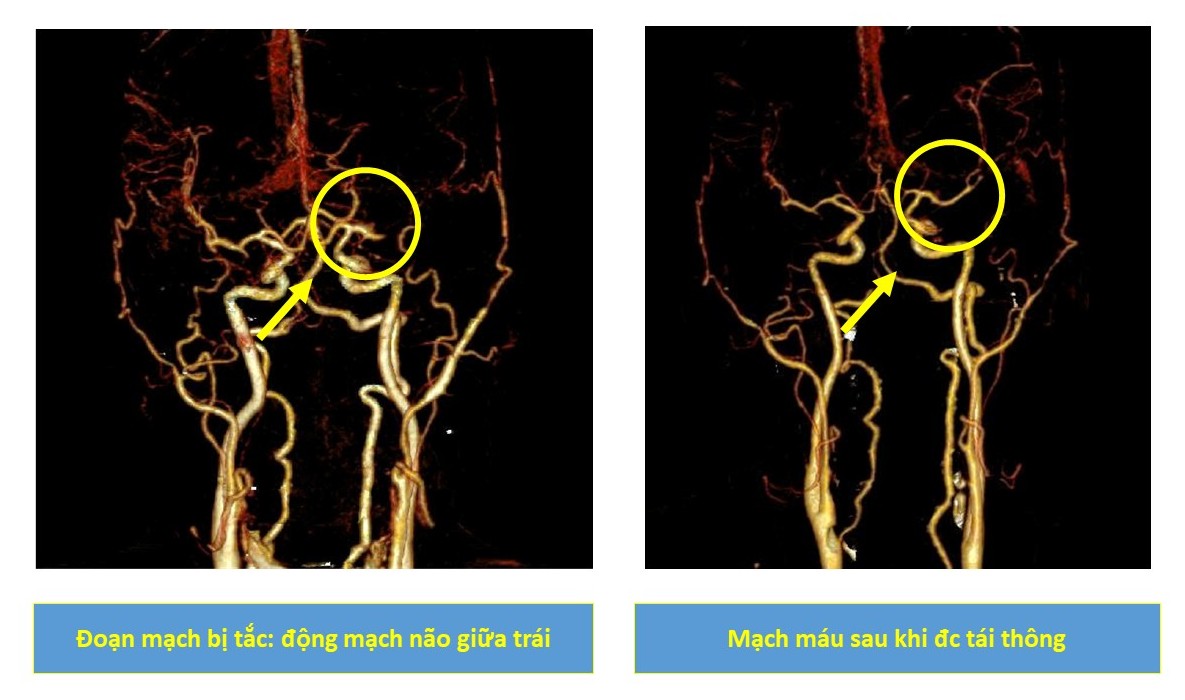 Cấp cứu kịp thời người bệnh đột quỵ não nhờ Mạng lưới cấp cứu kết nối tuyến cơ sở 