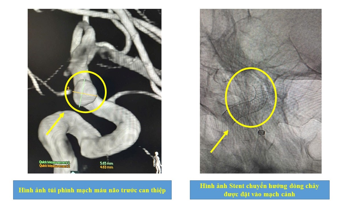 Can thiệp điều trị phình mạch máu não bằng kỹ thuật cao: Đặt stent chuyển dòng tại Bệnh viện Đa khoa tỉnh Phú Thọ
