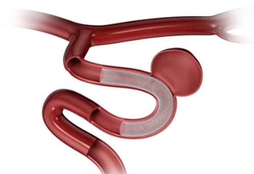 Can thiệp điều trị phình mạch máu não bằng kỹ thuật cao: Đặt stent chuyển dòng tại Bệnh viện Đa khoa tỉnh Phú Thọ