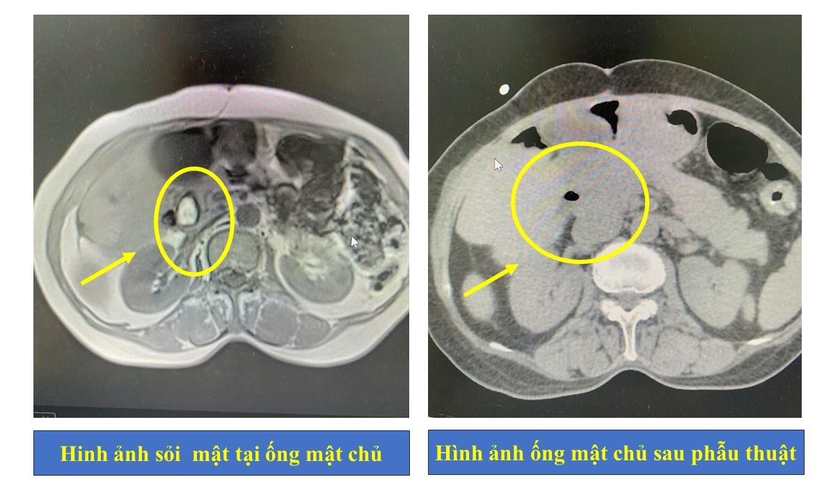 Hy hữu: Người bệnh cùng lúc bị sỏi mật gây tắc ống mật và giun trong đường mật