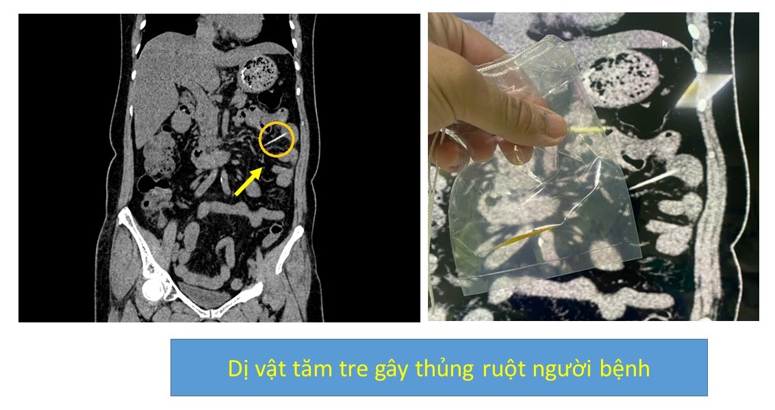 Liên tiếp xử trí 2 trường hợp thủng đường tiêu hóa do nuốt phải dị vật: Cảnh báo những thói quen nguy hiểm nhiều người mắc phải