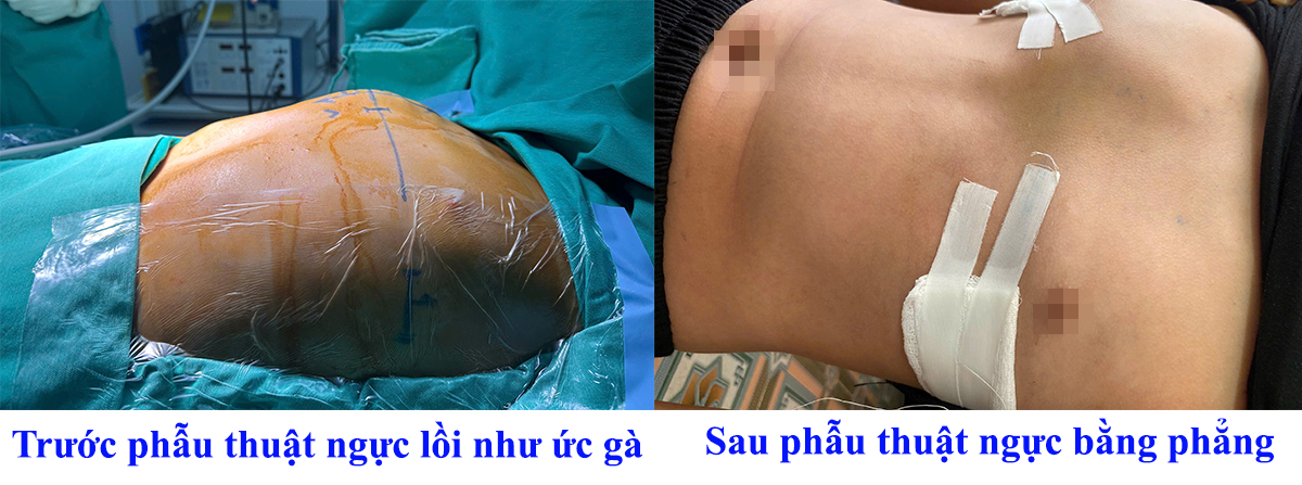 Ngực lồi lên như ức gà, cậu bé 12 tuổi thay đổi ngoại hình ngoạn mục sau khi đến Bệnh viện Đa khoa tỉnh Phú Thọ