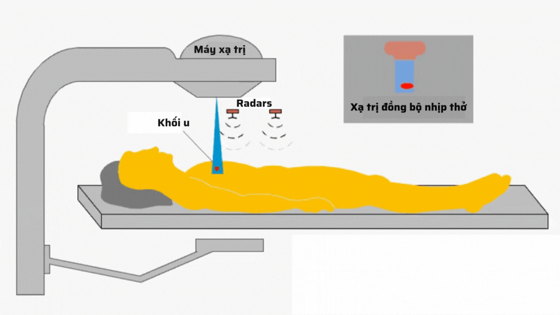 Đồng bộ nhịp thở: Công nghệ xạ trị thông minh cho người bệnh ung thư