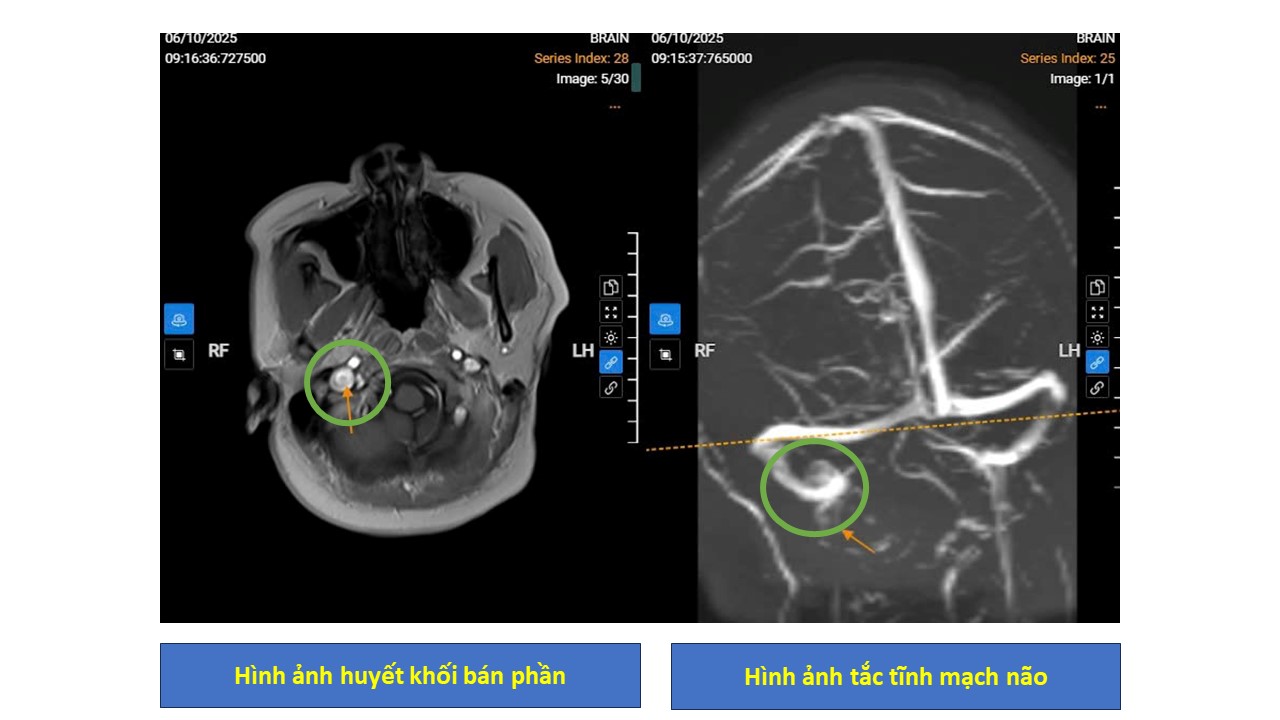 Hình ảnh chụp MRI tĩnh mạch não, phát hiện huyết khối bán phần tĩnh mạch cảnh trong