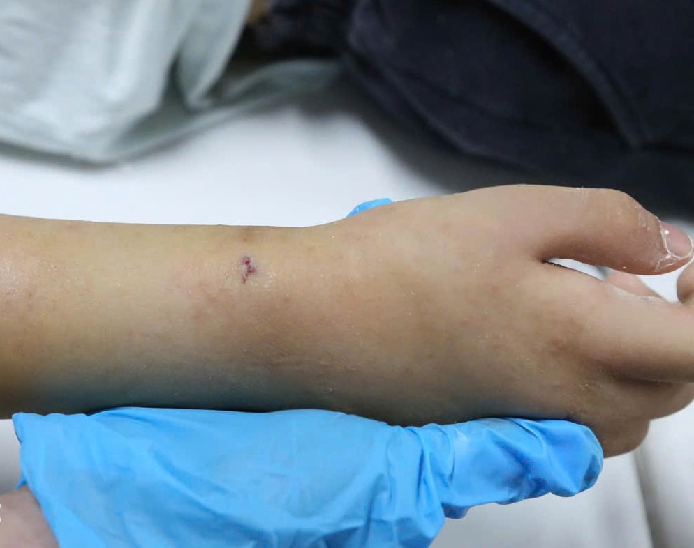 Nhờ ứng dụng kỹ thuật C-arm trong phẫu thuật, vết mổ của người bệnh rất nhỏ, gần như không để lại sẹo, mang lại hiệu quả thẩm mỹ cao.