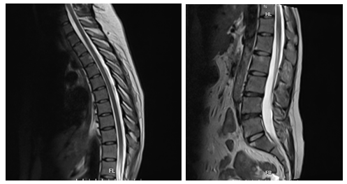 Hình ảnh chụp cộng hưởng từ cột sống ngực và cột sống lưng của người bệnh