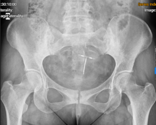 Hình ảnh phim chụp Xquang khớp cùng chậu của người bệnh: Viêm khớp cùng chậu độ III