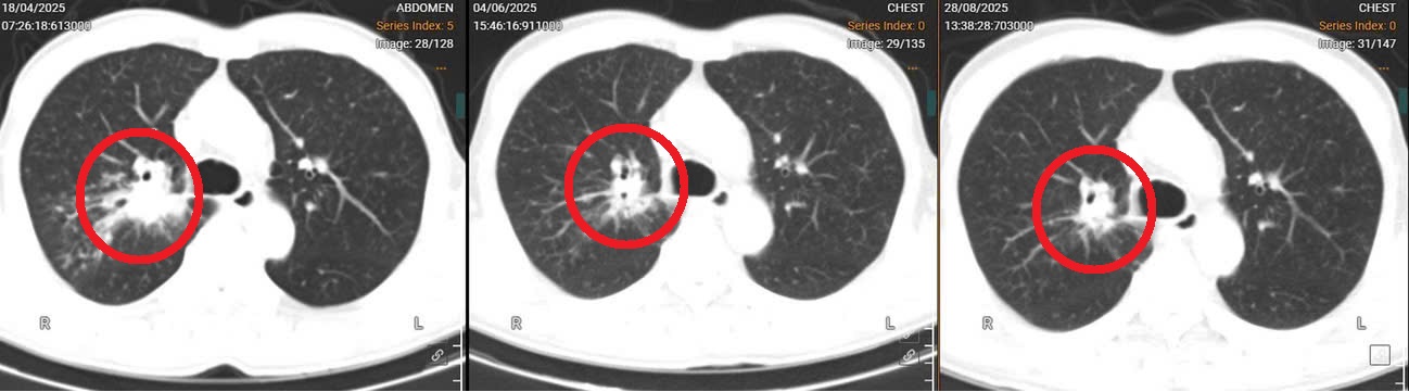 Trung tâm Ung bướu – Bệnh viện Đa khoa tỉnh Phú Thọ: Đón đầu kỷ nguyên miễn dịch mang lại cơ hội cho người bệnh ung thư 1 Hình ảnh phim chụp CT phổi cho thấy kích thước khối u của người bệnh đã giảm dần sau các chu kỳ điều trị