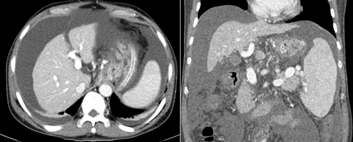 Hình ảnh xơ gan và dịch ổ bụng mức độ nhiều trên phim chụp cắt lớp vi tính của người bệnh