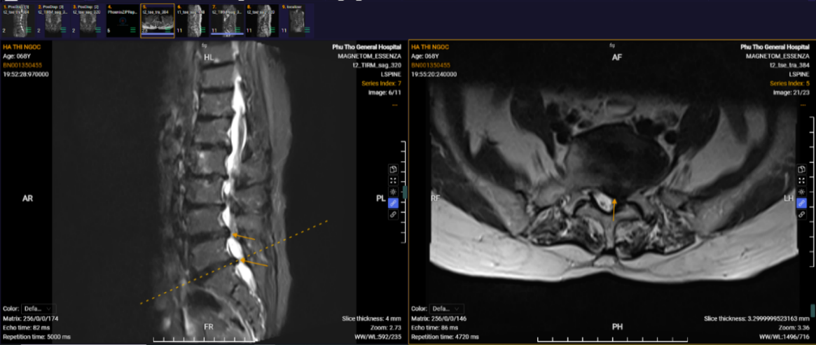 Bệnh viện Đa khoa tỉnh Phú Thọ ứng dụng thành công kỹ thuật nội soi AUSS hiện đại trong điều trị thoát vị đĩa đệm 2 tầng: Bước tiến mới trong phẫu thuật cột sống ít xâm lấn 2 Hình ảnh phim chụp của người bệnh Hà Thị Ngọc khi vào viện.