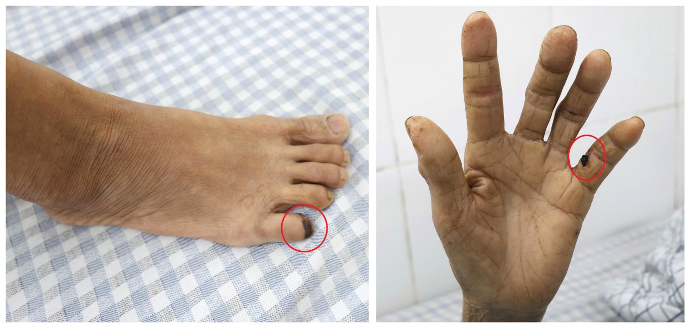 Một số vết thương rất nhỏ nhưng khiến người bệnh mắc uốn ván nguy hiểm