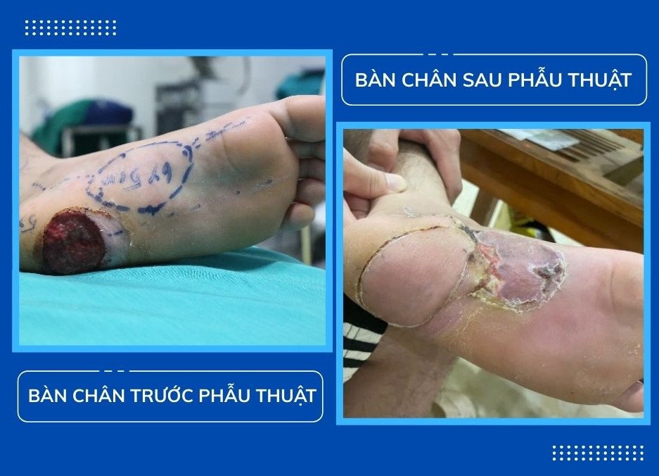 Phẫu thuật chuyển vạt che phủ khuyết phần mềm vùng gót chân cho người bệnh bị biến chứng do bỏng ống xả xe máy 3 a3 7