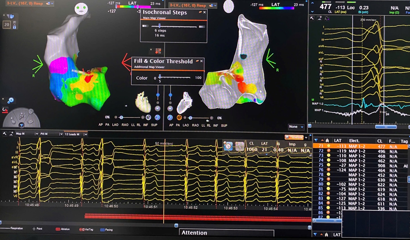 Hình ảnh bản đồ 3D buồng tim thể hiện chi tiết và chính xác vị trí ổ phát nhịp bất thường