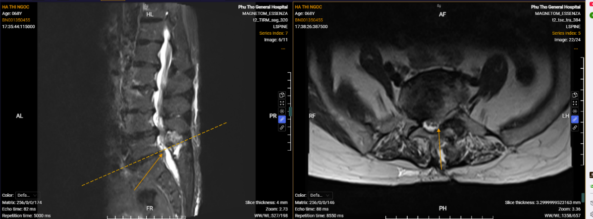 Bệnh viện Đa khoa tỉnh Phú Thọ ứng dụng thành công kỹ thuật nội soi AUSS hiện đại trong điều trị thoát vị đĩa đệm 2 tầng: Bước tiến mới trong phẫu thuật cột sống ít xâm lấn 3 Hình ảnh phim chụp của người bệnh Hà Thị Ngọc sau phẫu thuật.