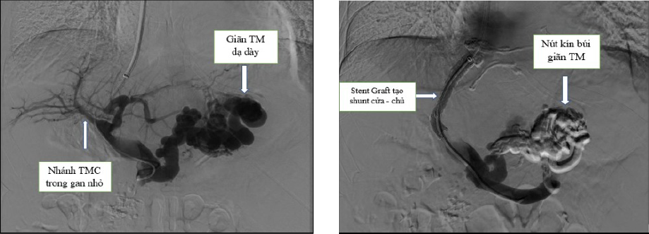 Kỹ thuật TIPS trên một ca bệnh chảy máu do giãn tĩnh mạch dạ dày.