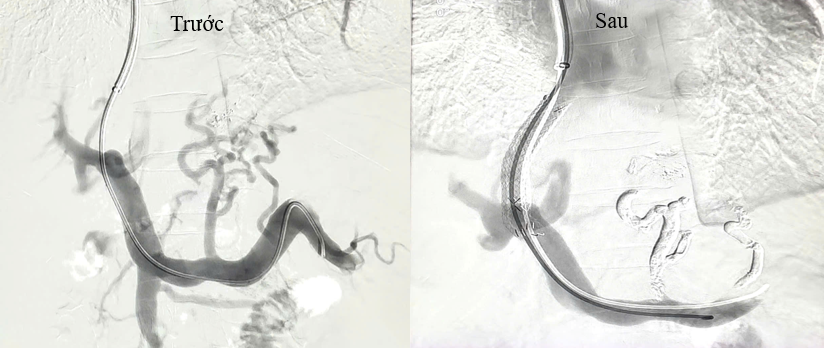 Hình ảnh trước và sau khi đặt stent TIPS trong gan và nút tắc các búi giãn tĩnh mạch thực quản.