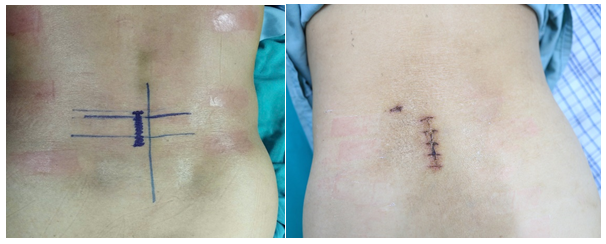 Bệnh viện Đa khoa tỉnh Phú Thọ ứng dụng thành công kỹ thuật nội soi AUSS hiện đại trong điều trị thoát vị đĩa đệm 2 tầng: Bước tiến mới trong phẫu thuật cột sống ít xâm lấn 5 Vị trí đường mổ và vết mổ của người bệnh.