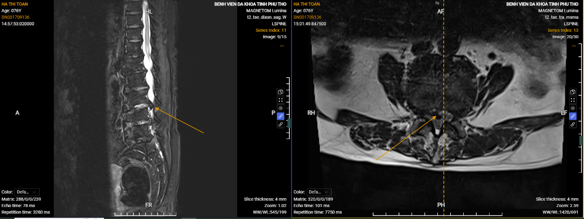 Bệnh viện Đa khoa tỉnh Phú Thọ ứng dụng thành công kỹ thuật nội soi AUSS hiện đại trong điều trị thoát vị đĩa đệm 2 tầng: Bước tiến mới trong phẫu thuật cột sống ít xâm lấn 7 Hình ảnh phim chụp thể hiện vị trí thoát vị của người bệnh Hà Thị Toản.