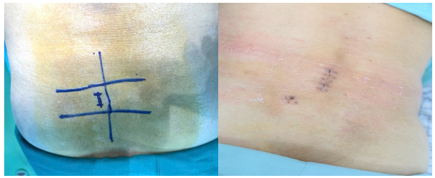 Bệnh viện Đa khoa tỉnh Phú Thọ ứng dụng thành công kỹ thuật nội soi AUSS hiện đại trong điều trị thoát vị đĩa đệm 2 tầng: Bước tiến mới trong phẫu thuật cột sống ít xâm lấn 8 Vị trí đường mổ và vết mổ của người bệnh Hà Thị Toản.