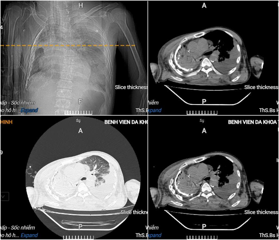 Giành lại sự sống cho người bệnh bị sốc nhiễm khuẩn, áp-xe phổi nguy kịch tại Bệnh viện Đa khoa tỉnh Phú Thọ 2 Hình ảnh cắt lớp vi tính lồng ngực của người bệnh cho thấy có áp-xe phổi trái lớn, tràn dịch màng phổi phải