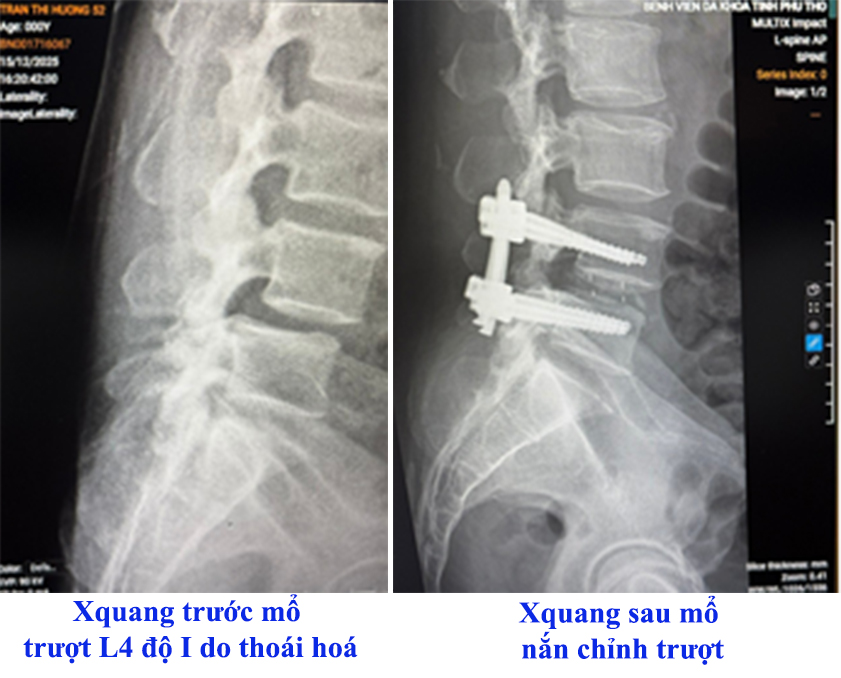 Hình ảnh phim chụp xquang của người bệnh