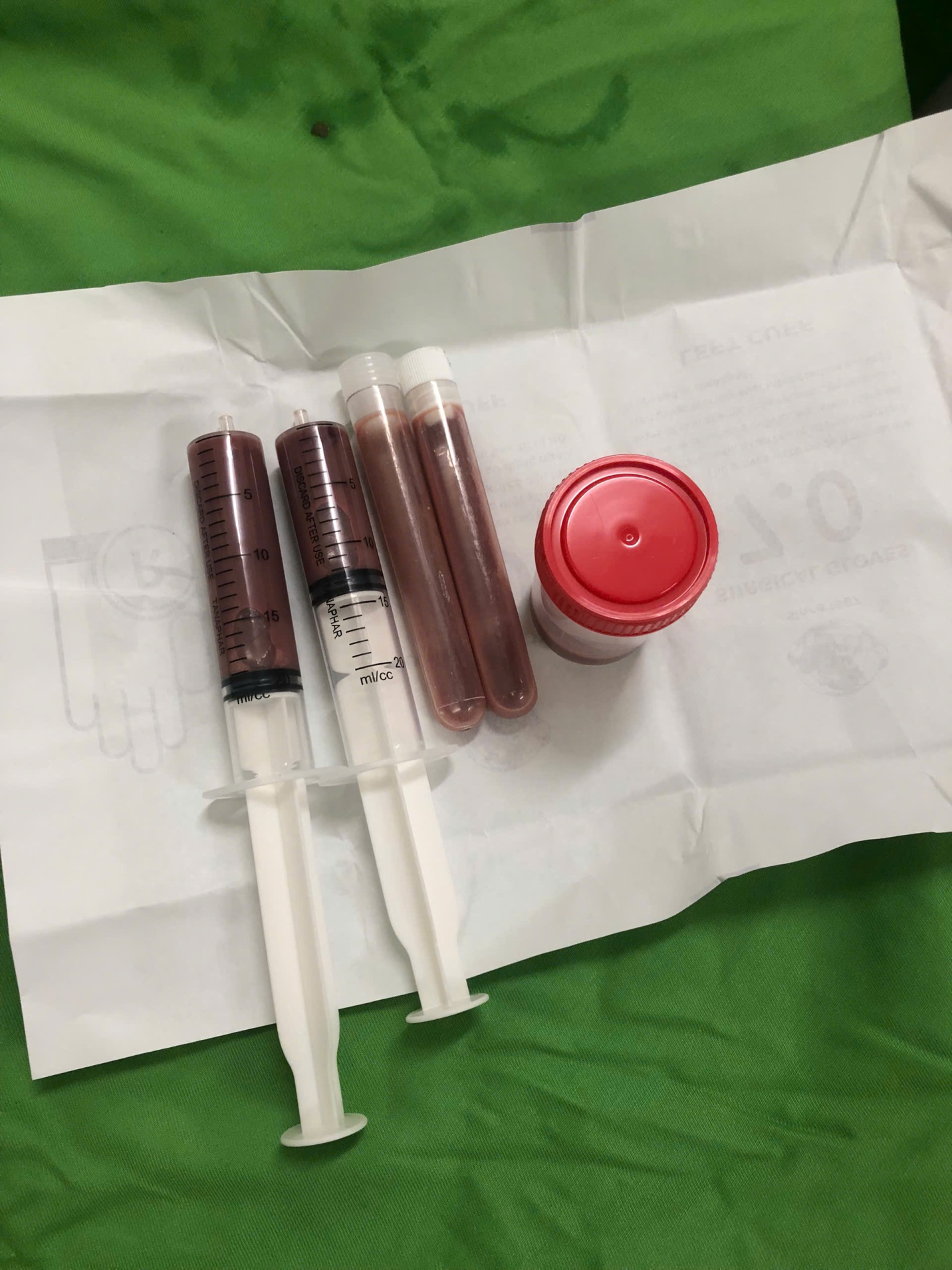 Người bệnh Tuyên Quang thoát nguy kịch do nhiễm trùng huyết từ áp xe gan nhờ được can thiệp kịp thời tại Bệnh viện Đa khoa tỉnh Phú Thọ 2 Hình ảnh dịch mủ áp xe gan của người bệnh sau khi được hút ra