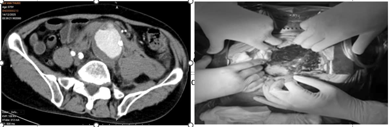 Hình ảnh khối máu tụ do vỡ động mạch chủ bụng trên phim chụp CLVT và sau khi mở bụng