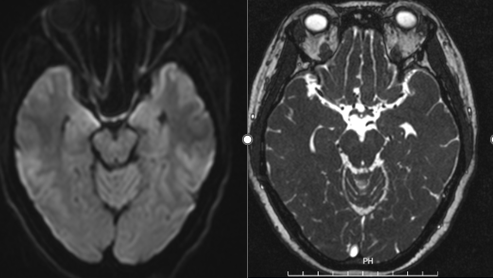 Hình ảnh kết quả chụp cộng hưởng từ của người bệnh