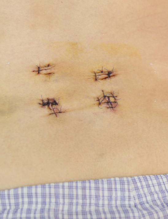 Vết mổ nhỏ, thẩm mỹ