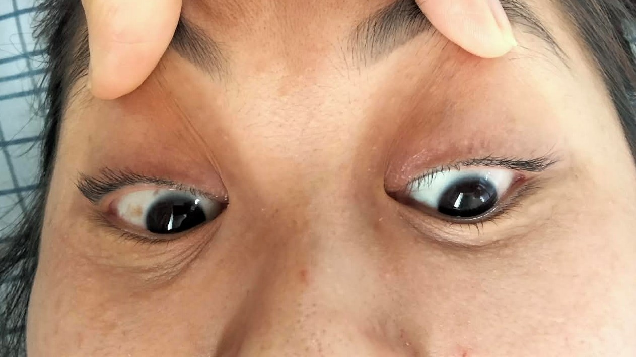 Hình ảnh khám vận động nhãn cầu của người bệnh sau điều trị: hai bên mắt đã cân xứng, có thể nhìn lên trên, xuống dưới rõ ràng, hết triệu chứng nhìn đôi