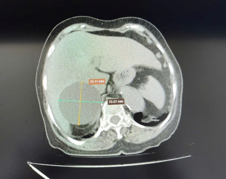 Chọc hút nang gan kích thước lớn giúp ổn định sức khỏe cho người bệnh cao tuổi có nhiều bệnh nền tại Bệnh viện Đa khoa tỉnh Phú Thọ 1 Hình ảnh phim chụp CT ổ bụng người bệnh cho thấy nang gan kích thước lớn