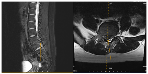 Thoát vị đĩa đệm đốt sống thắt lưng – Cảnh giác với bệnh lý hiếm gặp ở trẻ em và thanh thiếu niên 1 Phim chụp thể hiện vị trí thoát vị của người bệnh B.G.H khi vào viện